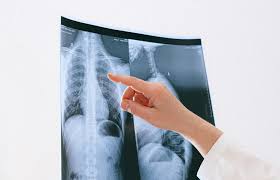 Respiratory Medicine/TB and Chest